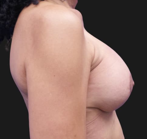 Case 23462, Performed By Dr. Tehrani – After