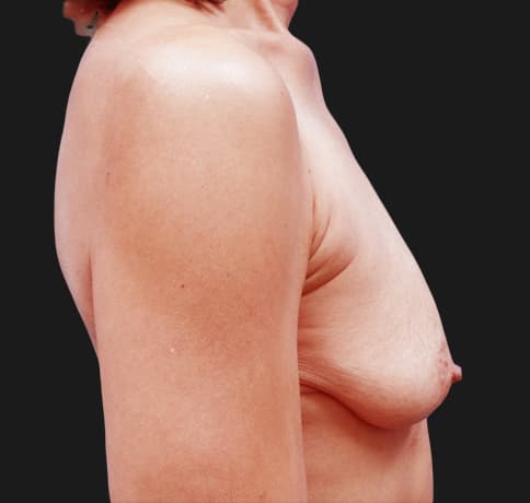 Case 23462, Performed By Dr. Tehrani – Before