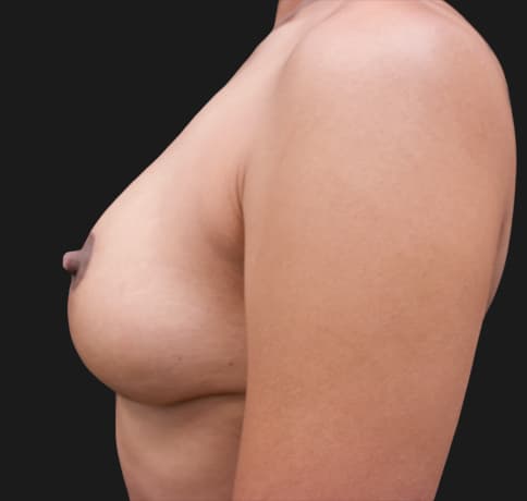 Case 55891, Performed By Dr. Tehrani – angle 4 After