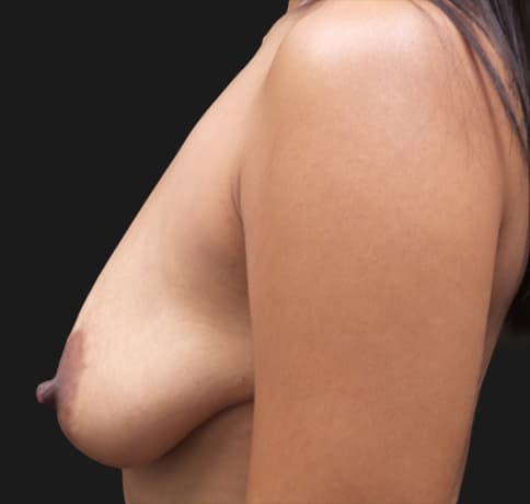 Case 55891, Performed By Dr. Tehrani – angle 4 Before