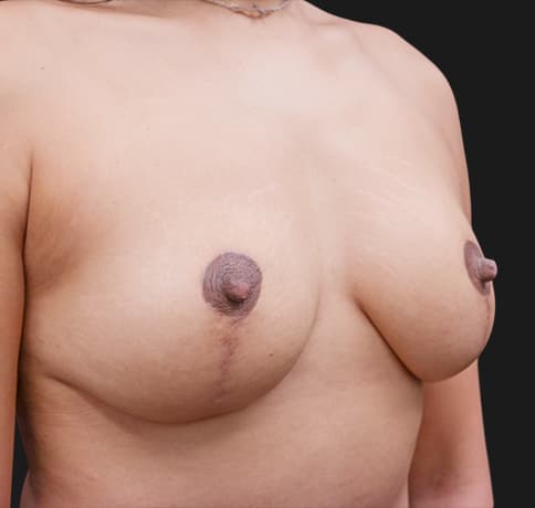 Case 55891, Performed By Dr. Tehrani – angle 2 After
