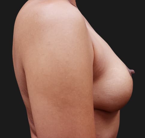 Case 55891, Performed By Dr. Tehrani – angle 5 After