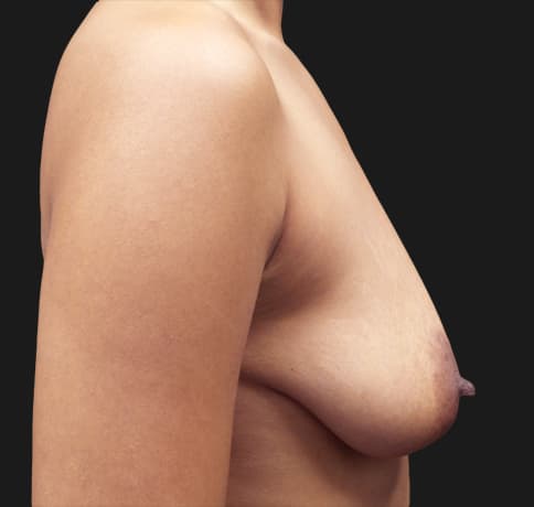 Case 55891, Performed By Dr. Tehrani – angle 5 Before