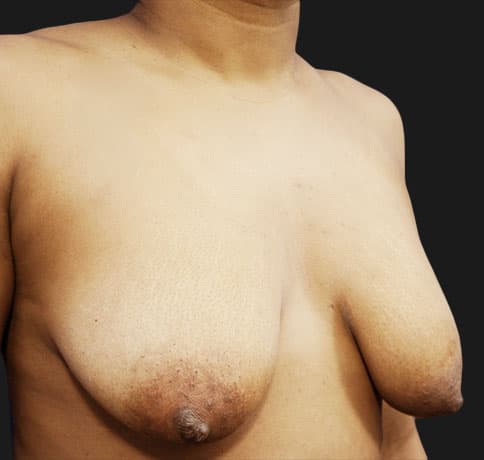 Case 16041, Performed By Dr. Tehrani – angle 2 Before