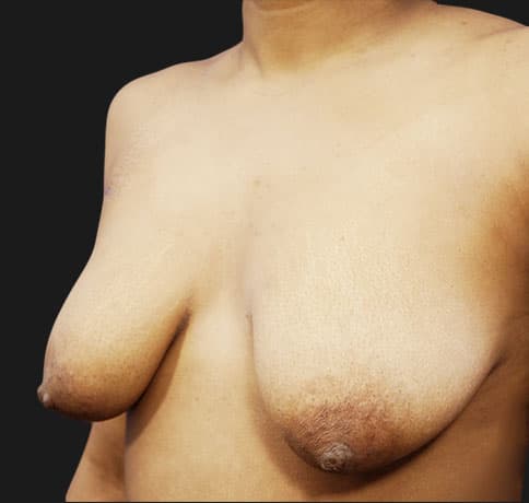 Case 16041, Performed By Dr. Tehrani – angle 3 Before