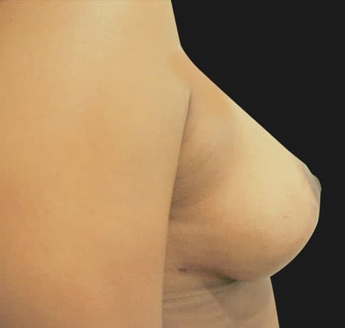 Case 16041, Performed By Dr. Tehrani – angle 4 After