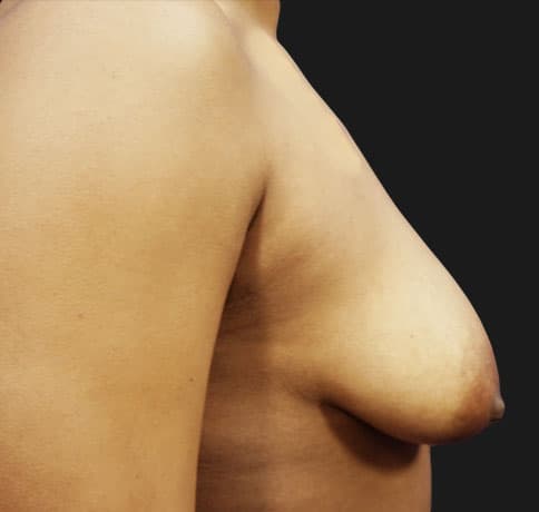 Case 16041, Performed By Dr. Tehrani – angle 4 Before
