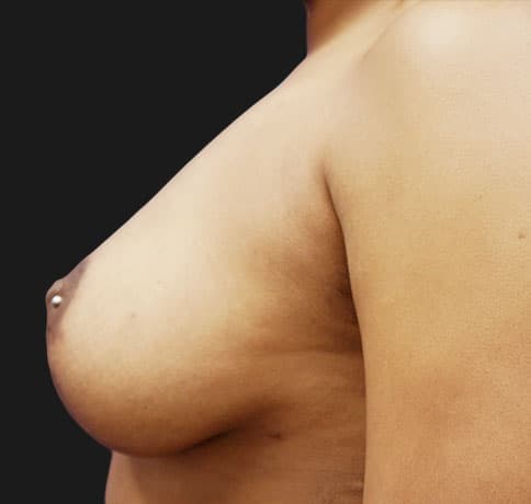 Case 16041, Performed By Dr. Tehrani – angle 5 After