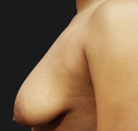 Case 16041, Performed By Dr. Tehrani – angle 5 Before