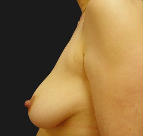 Case 2162, Performed By Dr. Tehrani – angle 4 Before