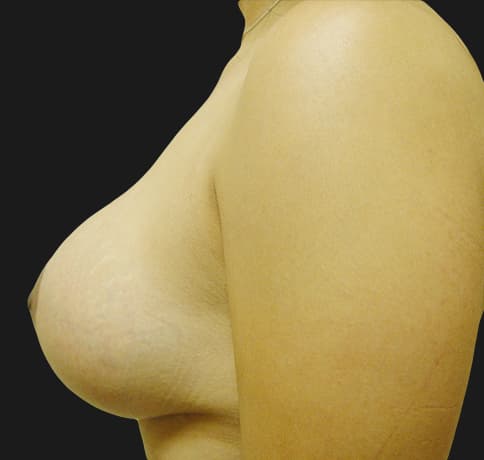 Case 7229 , Performed By Dr. Tehrani – angle 3 After