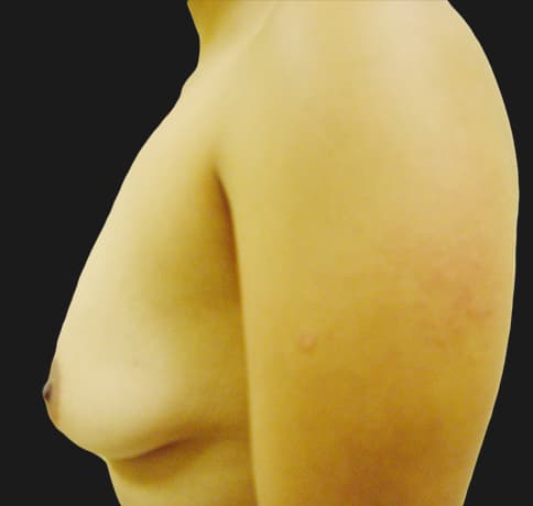 Case 7229 , Performed By Dr. Tehrani – angle 3 Before