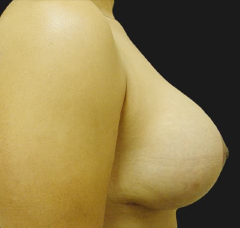 Case 7229 , Performed By Dr. Tehrani – angle 2 After
