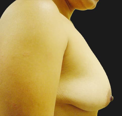 Case 7229 , Performed By Dr. Tehrani – angle 2 Before