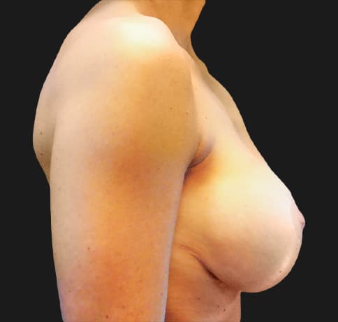 Case 8611 , Performed By Dr. Tehrani – angle 4 After