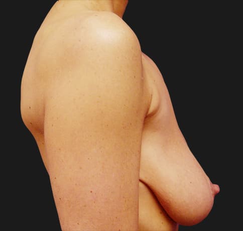 Case 8611 , Performed By Dr. Tehrani – angle 4 Before