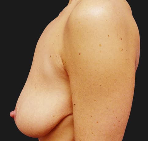 Case 8611 , Performed By Dr. Tehrani – angle 5 Before