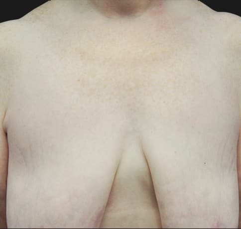 Case 23862, Performed By Dr. Tehrani – Before