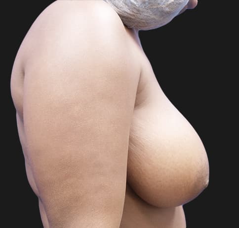 Case 36170 , Performed By Dr. Tehrani – angle 4 Before