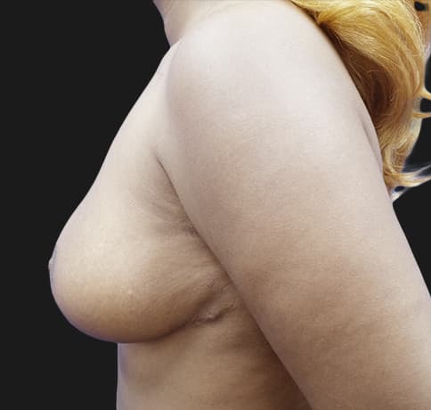 Case 36170 , Performed By Dr. Tehrani – angle 5 After