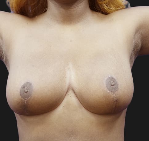 Case 36170 , Performed By Dr. Tehrani – angle 6 After