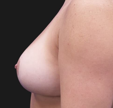 Case 35812 , Performed By Dr. Tehrani – angle 3 After
