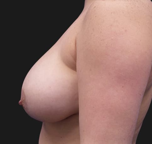 Case 35812 , Performed By Dr. Tehrani – angle 3 Before