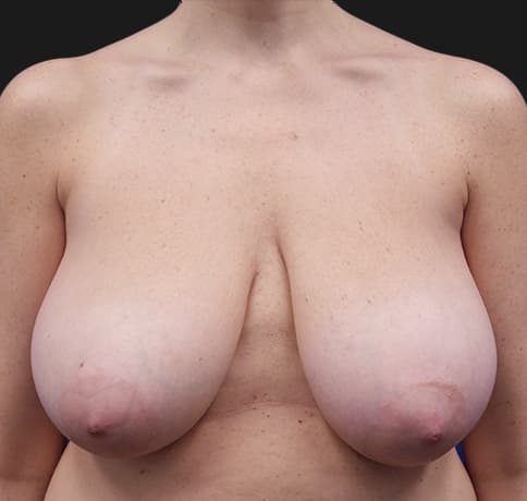 Case 37328 , Performed By Dr. Tehrani – Before