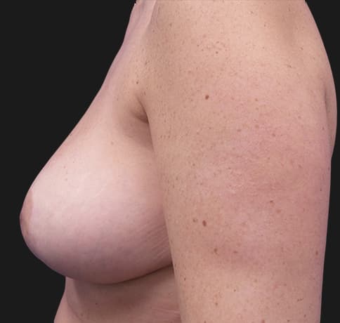 Case 37328 , Performed By Dr. Tehrani – angle 4 After
