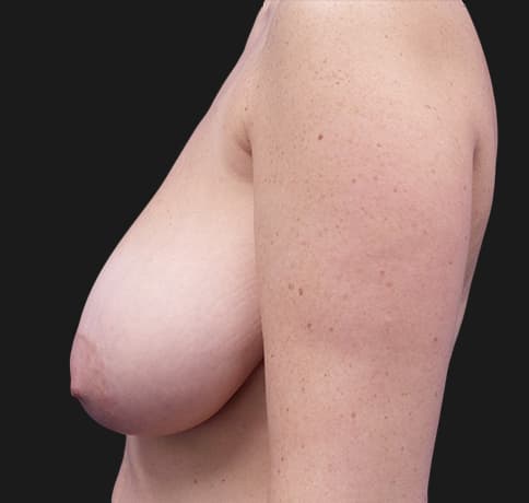Case 37328 , Performed By Dr. Tehrani – angle 4 Before
