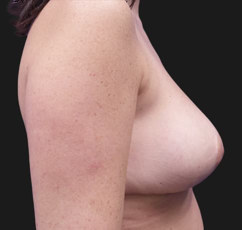 Case 37328 , Performed By Dr. Tehrani – angle 5 After