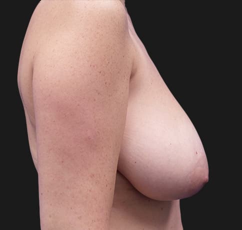Case 37328 , Performed By Dr. Tehrani – angle 5 Before