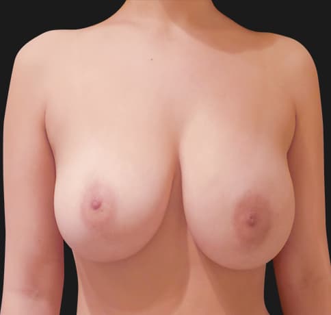 Case 39499 , Performed By Dr. Tehrani – After