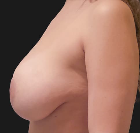 Case 39499 , Performed By Dr. Tehrani – angle 2 After