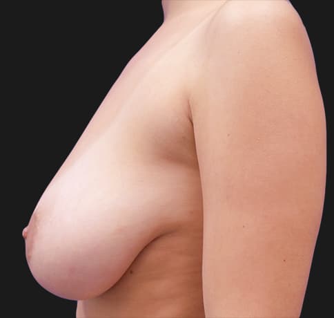 Case 39499 , Performed By Dr. Tehrani – angle 2 Before