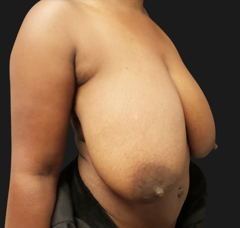 Case 54381, Performed By Dr. Tehrani – Before