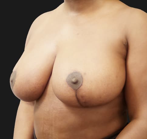 Case 54381, Performed By Dr. Tehrani – angle 3 After