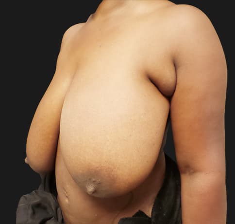 Case 54381, Performed By Dr. Tehrani – angle 3 Before