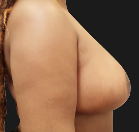Case 54381, Performed By Dr. Tehrani – angle 4 After