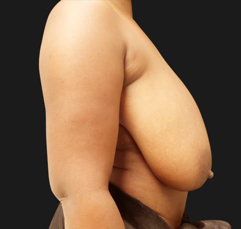 Case 54381, Performed By Dr. Tehrani – angle 4 Before
