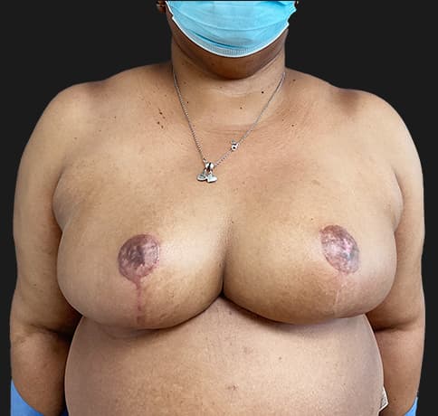 Case 57368, Performed By Dr. Tehrani – After