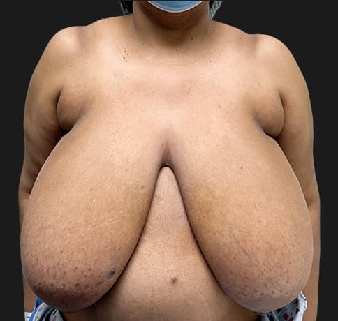Case 57368, Performed By Dr. Tehrani – Before