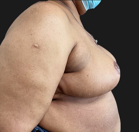 Case 57368, Performed By Dr. Tehrani – After