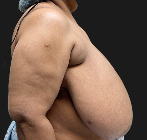 Case 57368, Performed By Dr. Tehrani – Before