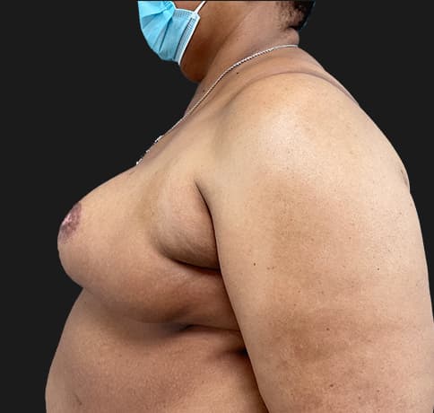 Case 57368, Performed By Dr. Tehrani – angle 3 After
