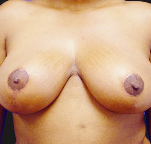Case 3394 , Performed By Dr. Tehrani – After