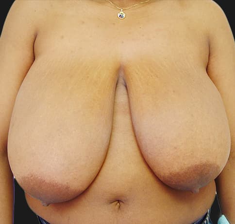 Case 3394 , Performed By Dr. Tehrani – Before