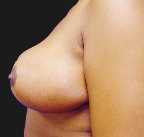 Case 3394 , Performed By Dr. Tehrani – angle 4 After