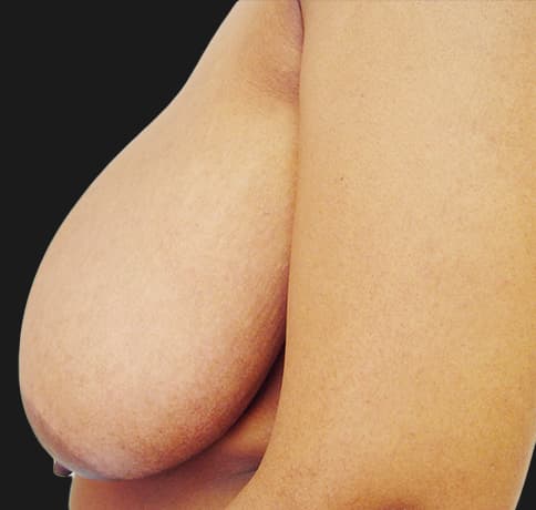 Case 3394 , Performed By Dr. Tehrani – angle 4 Before