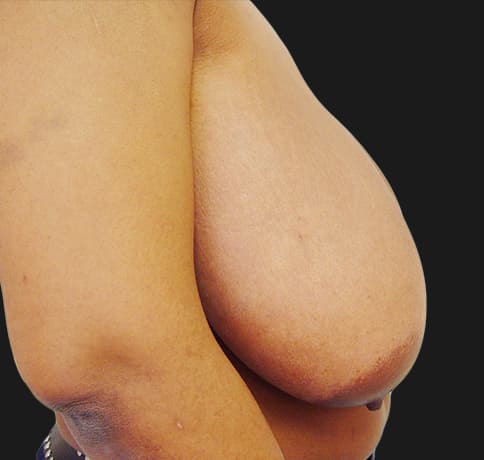 Case 3394 , Performed By Dr. Tehrani – angle 5 Before
